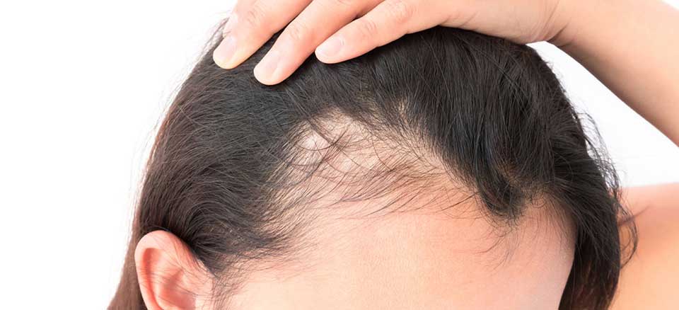 راهکارهای موثر در درمان ریزش مو با گیاهان دارویی، از روش‌های طبیعی تا مشاوره پزشکی